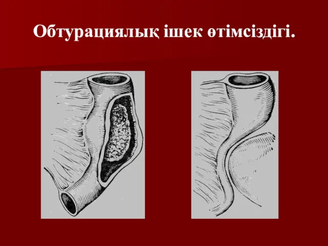 Обтурациялық ішек өтімсіздігі.