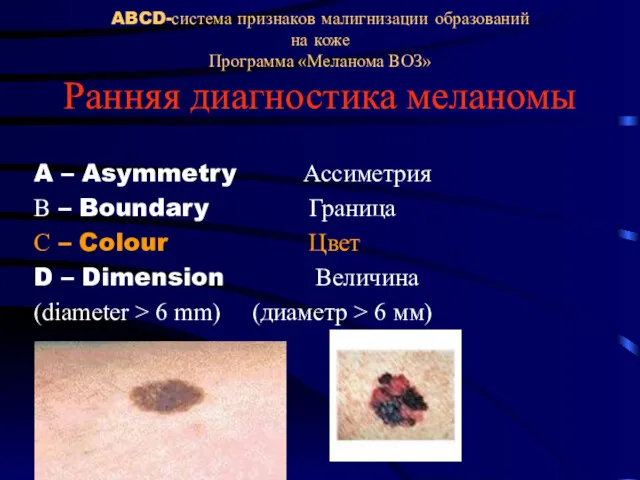 ABCD-система признаков малигнизации образований на коже Программа «Меланома ВОЗ» Ранняя диагностика меланомы A