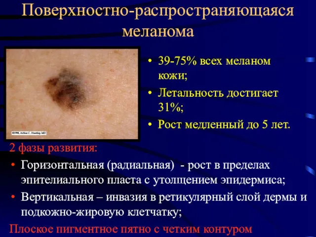 Поверхностно-распространяющаяся меланома 39-75% всех меланом кожи; Летальность достигает 31%; Рост медленный до 5