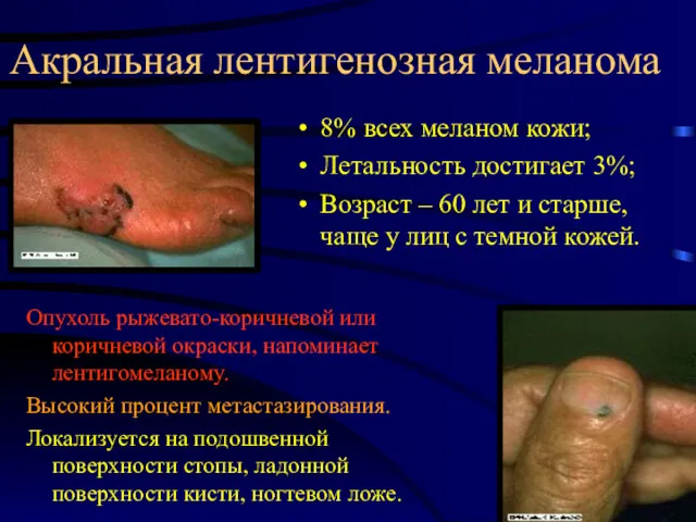Акральная лентигенозная меланома 8% всех меланом кожи; Летальность достигает 3%; Возраст – 60