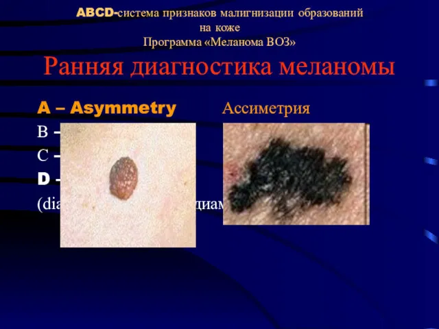 ABCD-система признаков малигнизации образований на коже Программа «Меланома ВОЗ» Ранняя диагностика меланомы A