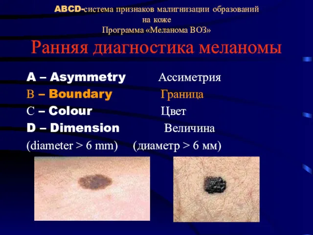 ABCD-система признаков малигнизации образований на коже Программа «Меланома ВОЗ» Ранняя диагностика меланомы A