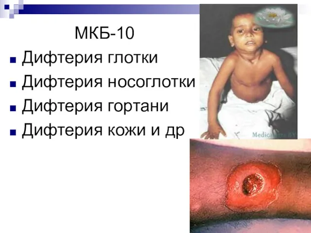 МКБ-10 Дифтерия глотки Дифтерия носоглотки Дифтерия гортани Дифтерия кожи и др
