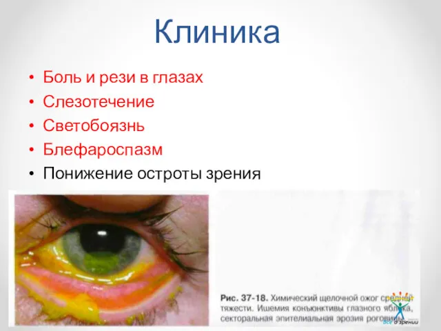 Клиника Боль и рези в глазах Слезотечение Светобоязнь Блефароспазм Понижение остроты зрения