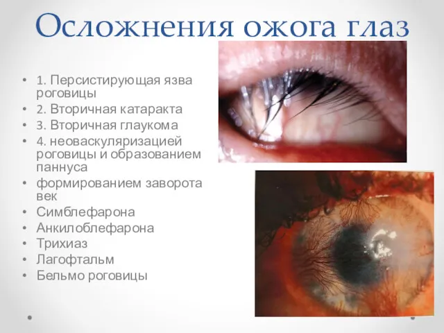 Осложнения ожога глаз 1. Персистирующая язва роговицы 2. Вторичная катаракта