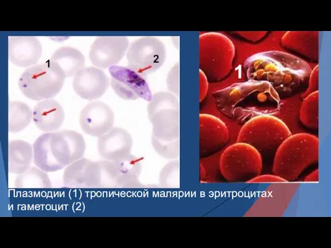 Плазмодии (1) тропической малярии в эритроцитах и гаметоцит (2) 1 2 1