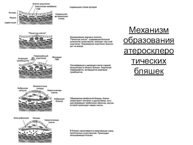 Механизм образования атеросклеротических бляшек