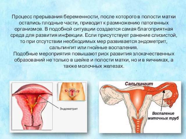 Процесс прерывания беременности, после которого в полости матки остались плодные