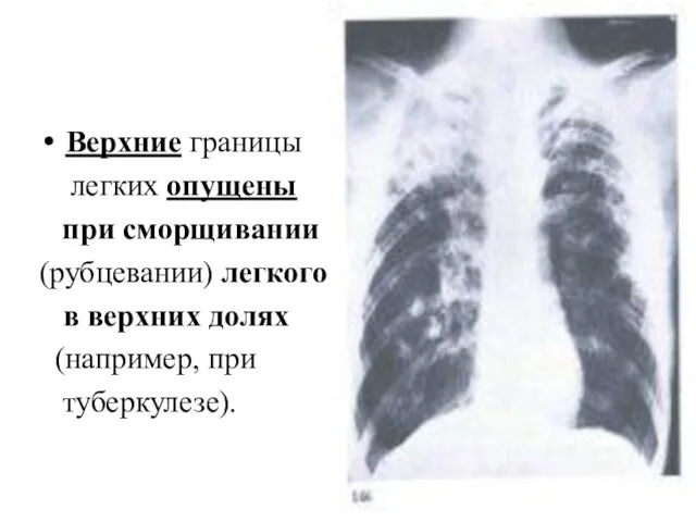 Верхние границы легких опущены при сморщивании (рубцевании) легкого в верхних долях (например, при туберкулезе).