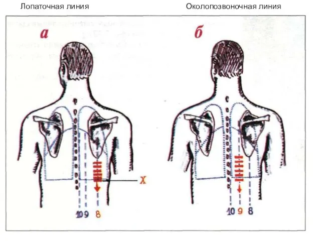 Лопаточная линия Околопозвоночная линия