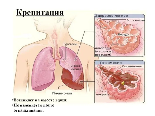 Крепитация Возникает на высоте вдоха; Не изменяется после откашливания.