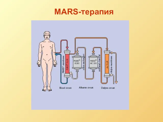 MARS-терапия