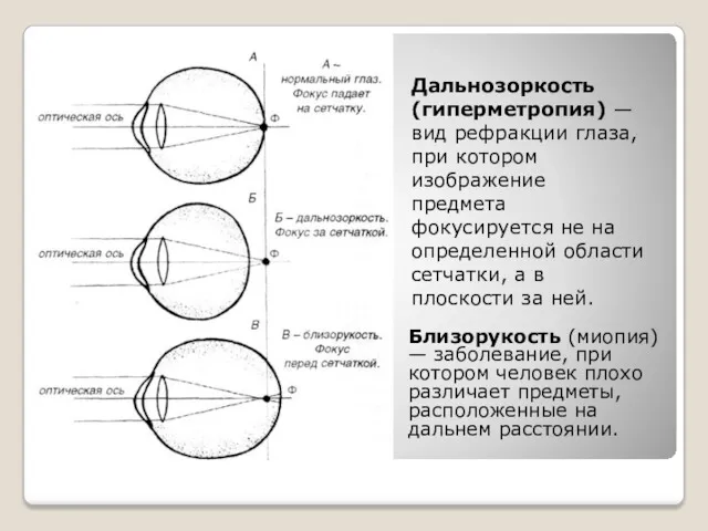 Близорукость (миопия) — заболевание, при котором человек плохо различает предметы, расположенные на дальнем