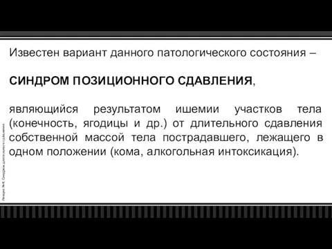 Лекция №4: Синдром длительного сдавления Известен вариант данного патологического состояния