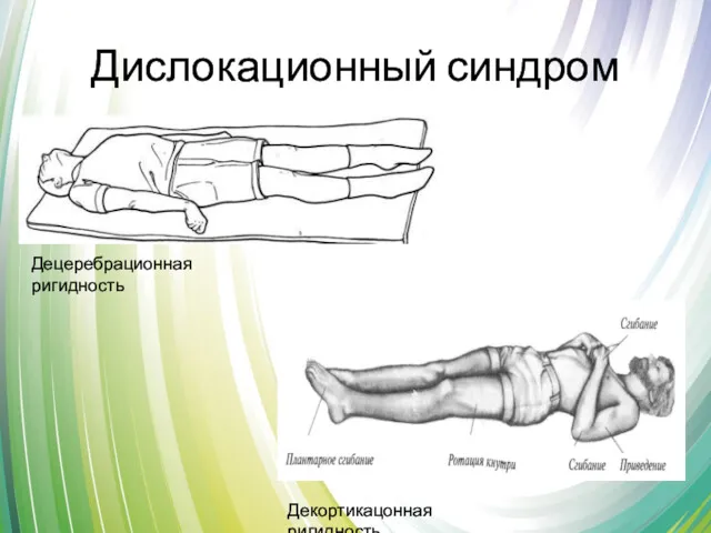 Дислокационный синдром Децеребрационная ригидность Декортикацонная ригидность