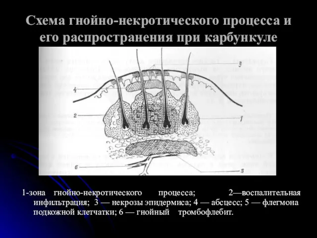 Схема гнойно-некротического процесса и его распространения при карбункуле 1-зона гнойно-некротического