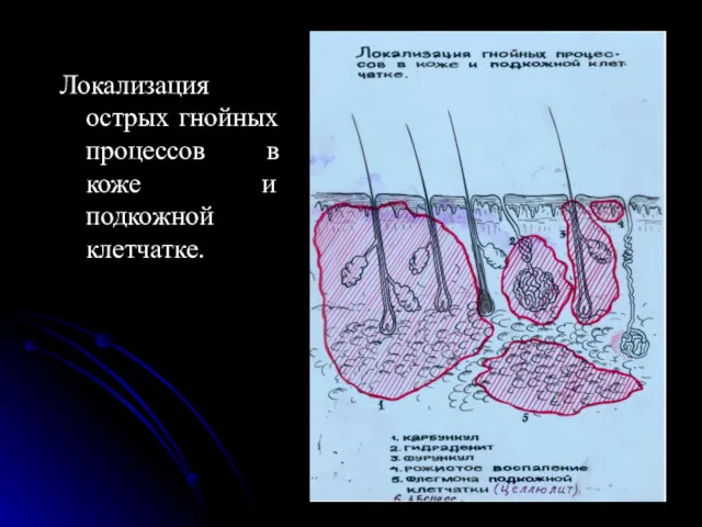 Локализация острых гнойных процессов в коже и подкожной клетчатке.