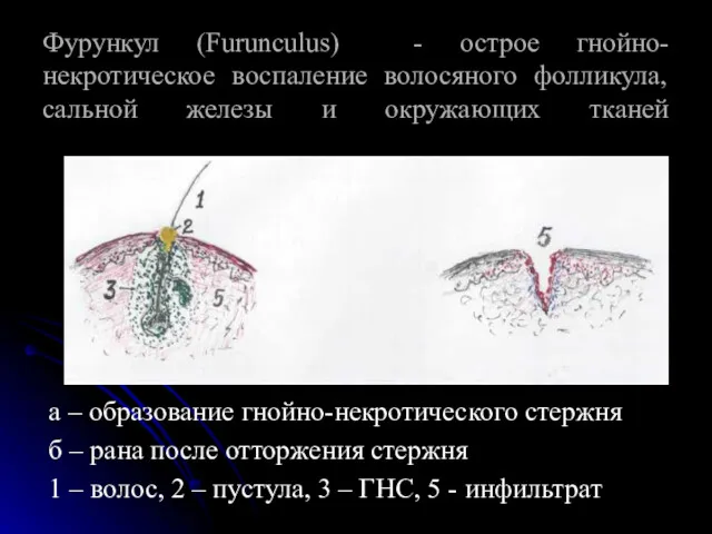 Фурункул (Furunculus) - острое гнойно-некротическое воспаление волосяного фолликула, сальной железы