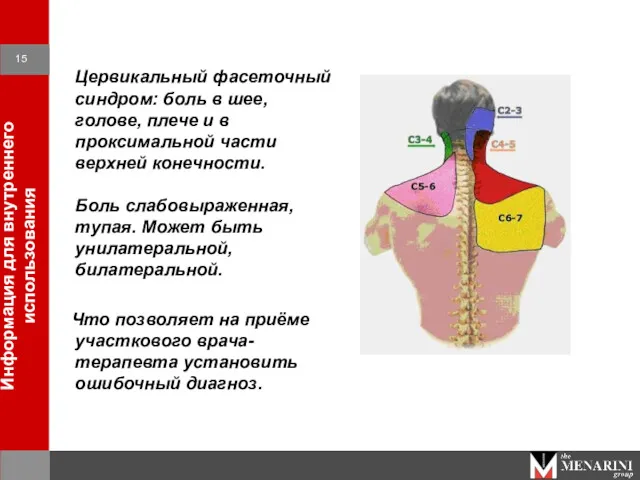 Цервикальный фасеточный синдром: боль в шее, голове, плече и в