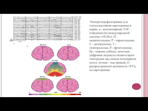 Электроэнцефалограмма и ее топоселективная картограмма в норме. а - монополярные