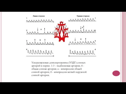 Ультразвуковая допплерограмма (УЗДГ) сонных артерий в норме. 1-3 - надблоковая