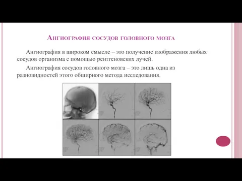 Ангиография сосудов головного мозга Ангиография в широком смысле – это