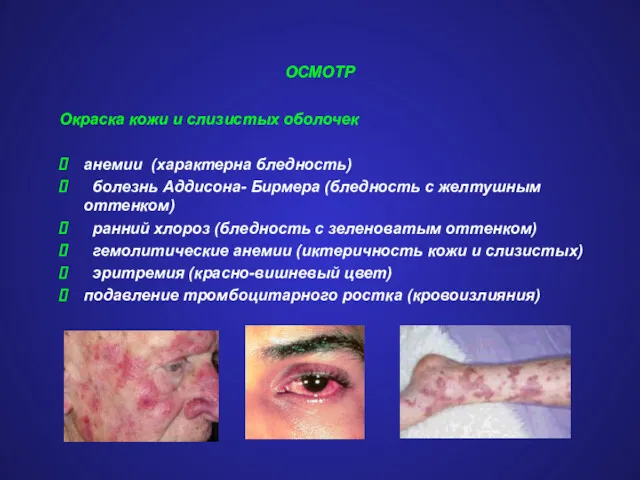 ОСМОТР Окраска кожи и слизистых оболочек анемии (характерна бледность) болезнь