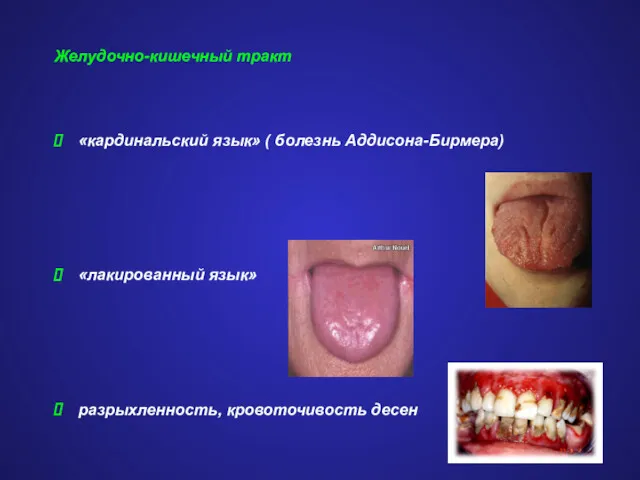 Желудочно-кишечный тракт «кардинальский язык» ( болезнь Аддисона-Бирмера) «лакированный язык» разрыхленность, кровоточивость десен