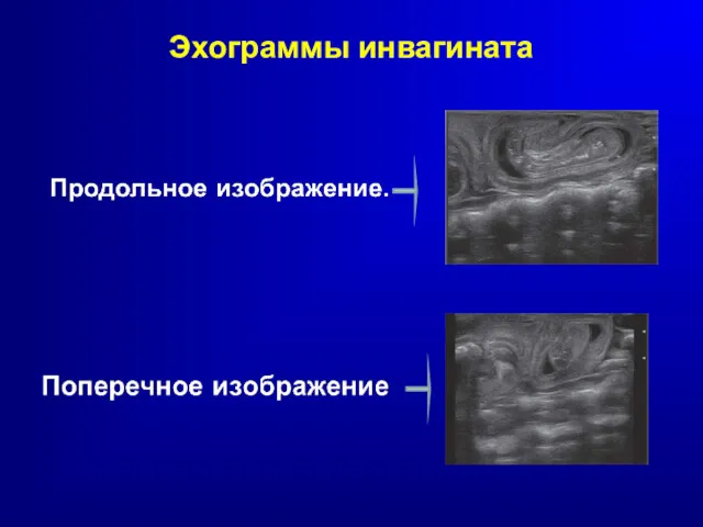 Эхограммы инвагината