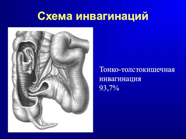 Схема инвагинаций Тонко-толстокишечная инвагинация 93,7%