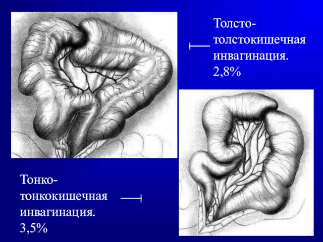 Толсто-толстокишечная инвагинация. 2,8% Тонко-тонкокишечная инвагинация. 3,5%