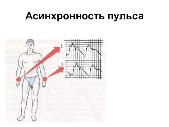 Асинхронность пульса