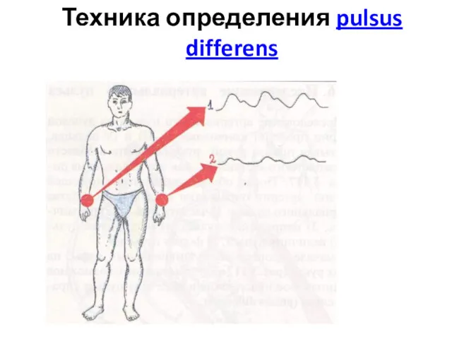 Техника определения pulsus differens