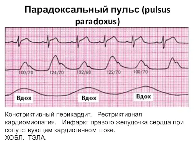 Парадоксальный пульс (pulsus paradoxus) Констриктивный перикардит, Рестриктивная кардиомиопатия. Инфаркт правого