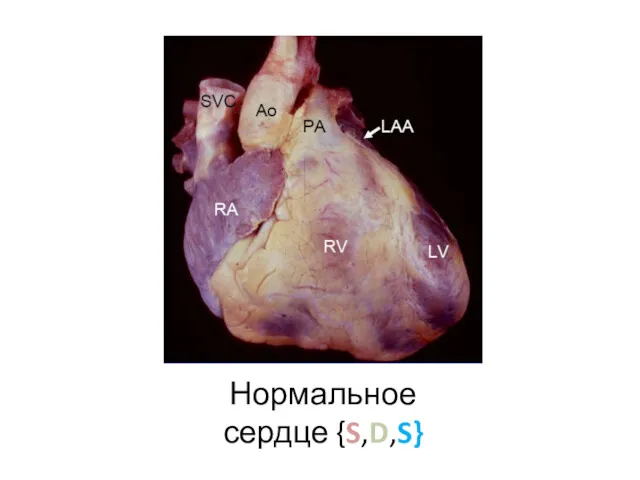 Нормальное сердце {S,D,S}