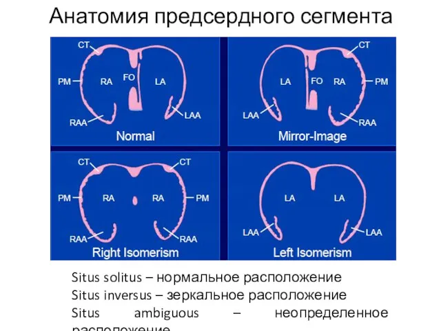 Анатомия предсердного сегмента Situs solitus – нормальное расположение Situs inversus