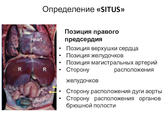 Определение «SITUS» Позиция правого предсердия Позиция верхушки сердца Позиция желудочков