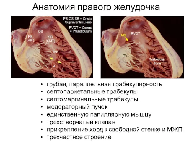 грубая, параллельная трабекулярность септопариетальные трабекулы септомаргинальные трабекулы модераторный пучек единственную