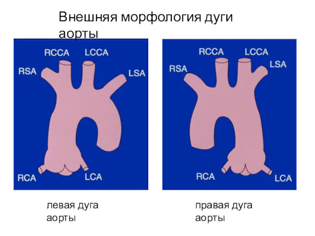 Внешняя морфология дуги аорты левая дуга аорты правая дуга аорты
