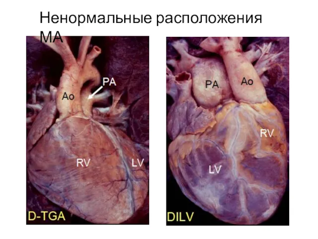 Ненормальные расположения МА