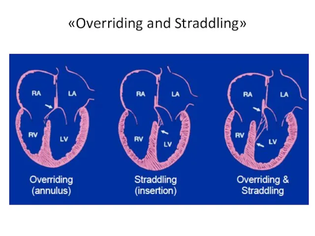 «Overriding and Straddling»