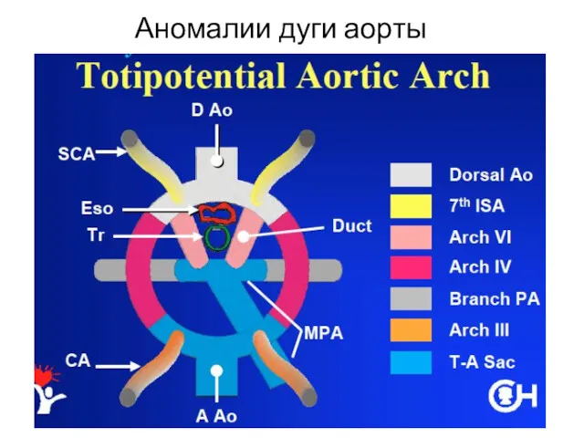 Аномалии дуги аорты
