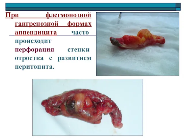 При флегмонозной гангренозной формах аппендицита часто происходит перфорация стенки отростка с развитием перитонита.