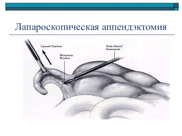 Лапароскопическая аппендэктомия