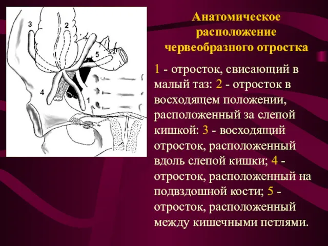 Анатомическое расположение червеобразного отростка 1 - отросток, свисающий в малый