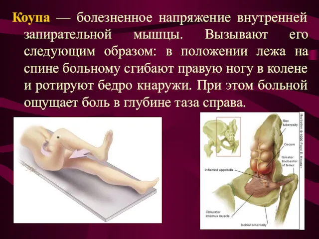 Коупа — болезненное напряжение внутренней запирательной мышцы. Вызывают его следующим