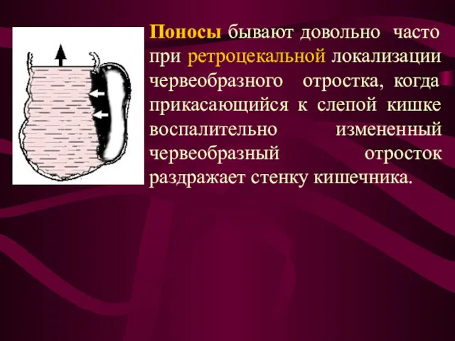 Поносы бывают довольно часто при ретроцекальной локализации червеобразного отростка, когда