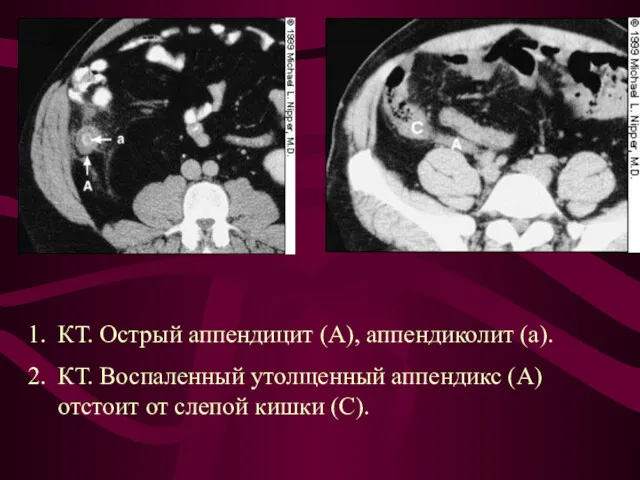 КТ. Острый аппендицит (А), аппендиколит (а). КТ. Воспаленный утолщенный аппендикс (А) отстоит от слепой кишки (С).