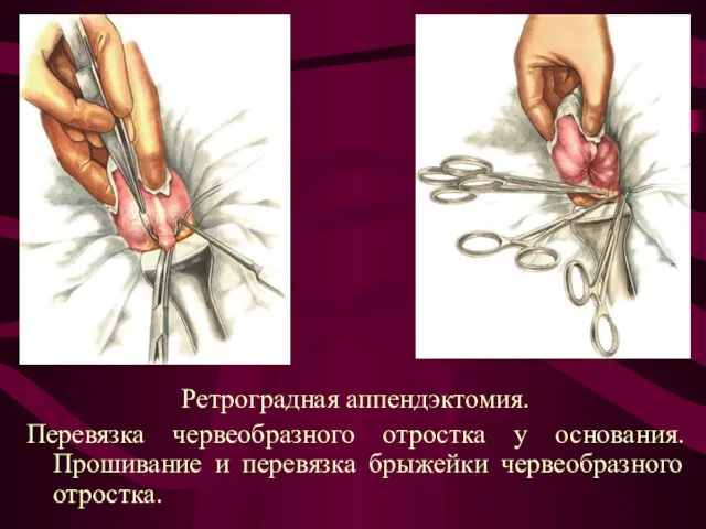 Ретроградная аппендэктомия. Перевязка червеобразного отростка у основания. Прошивание и перевязка брыжейки червеобразного отростка.