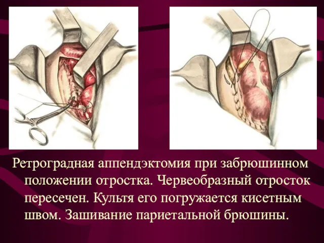 Ретроградная аппендэктомия при забрюшинном положении отростка. Червеобразный отросток пересечен. Культя